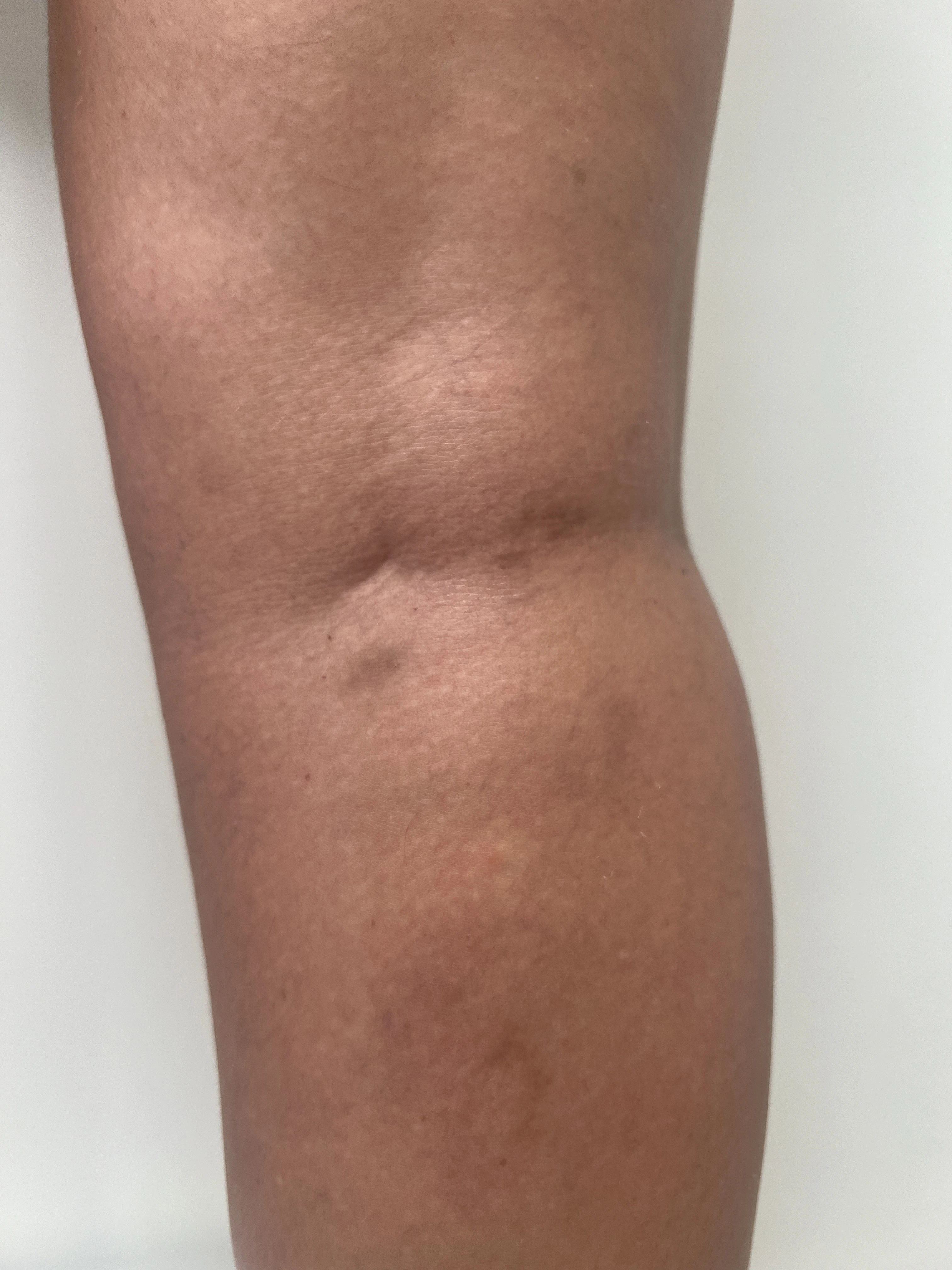Pernas depois do tratamento Espuma + Laser Transdérmico + Escleroterapia